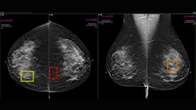mamografías con inteligencia artificial