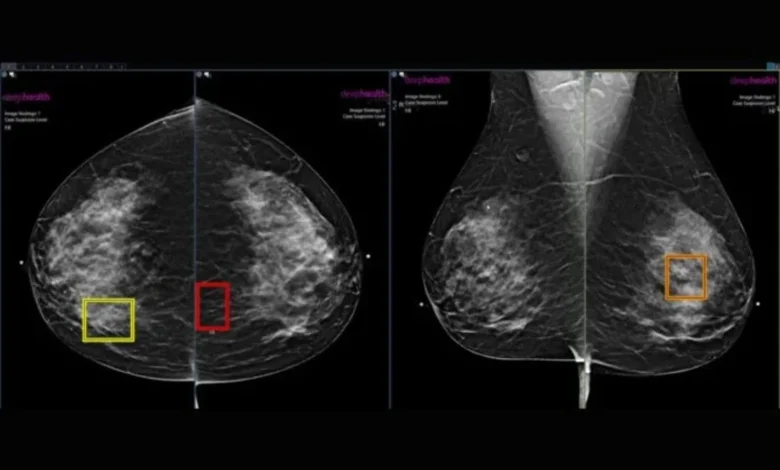 mamografías con inteligencia artificial