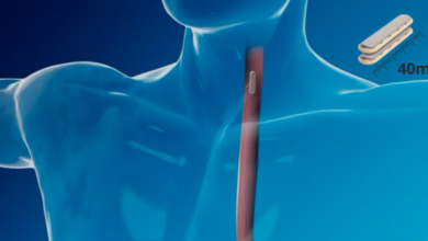 cirugía bariátrica con imanes