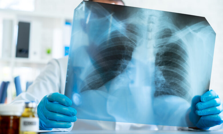 Cáncer de pulmón